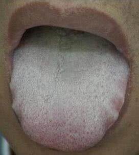 Lnague enduit beosin de gratte langue